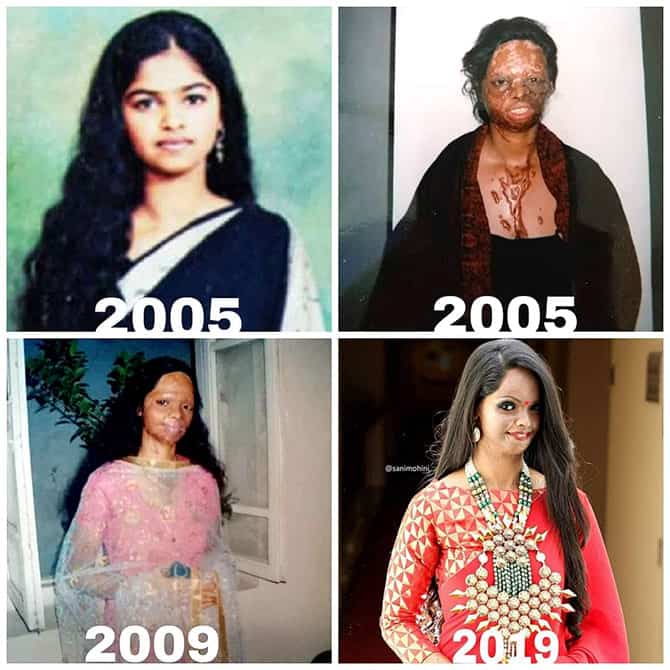 Laxmi Agarwal - Before and After picture of acid attack - 2005 - Celebinfo.wiki - images